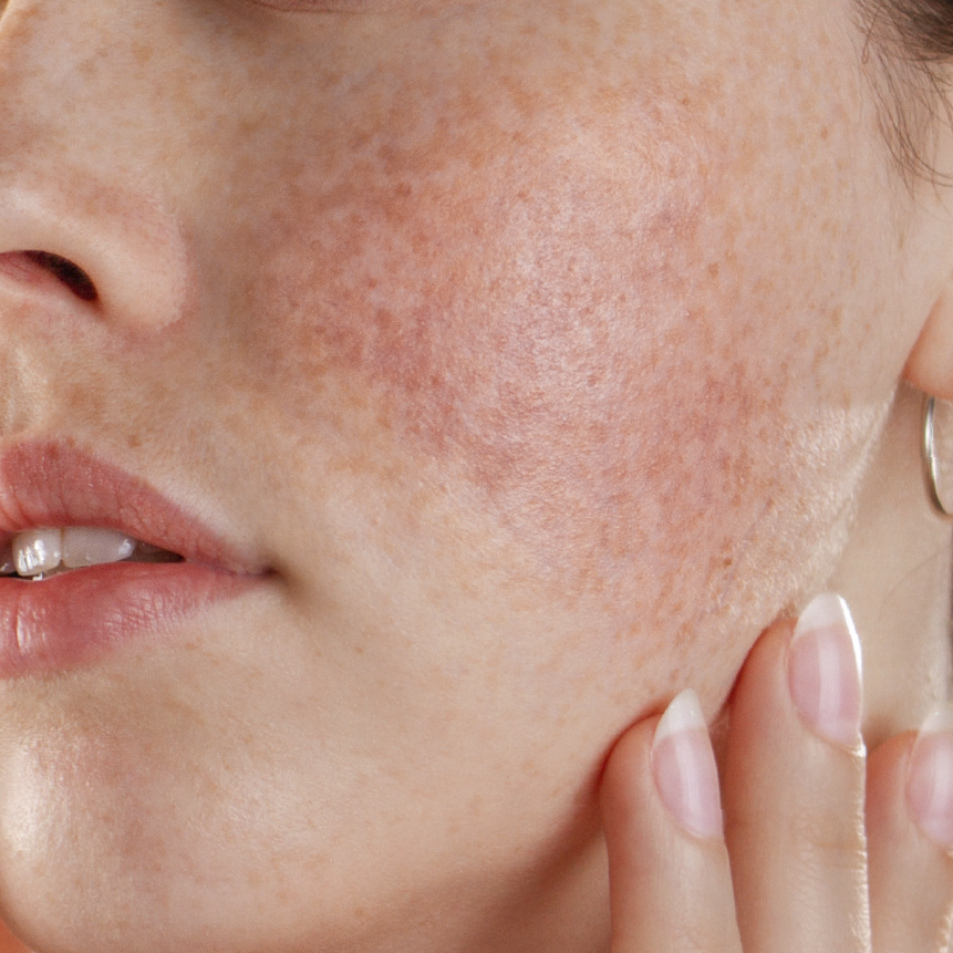 Rosacea